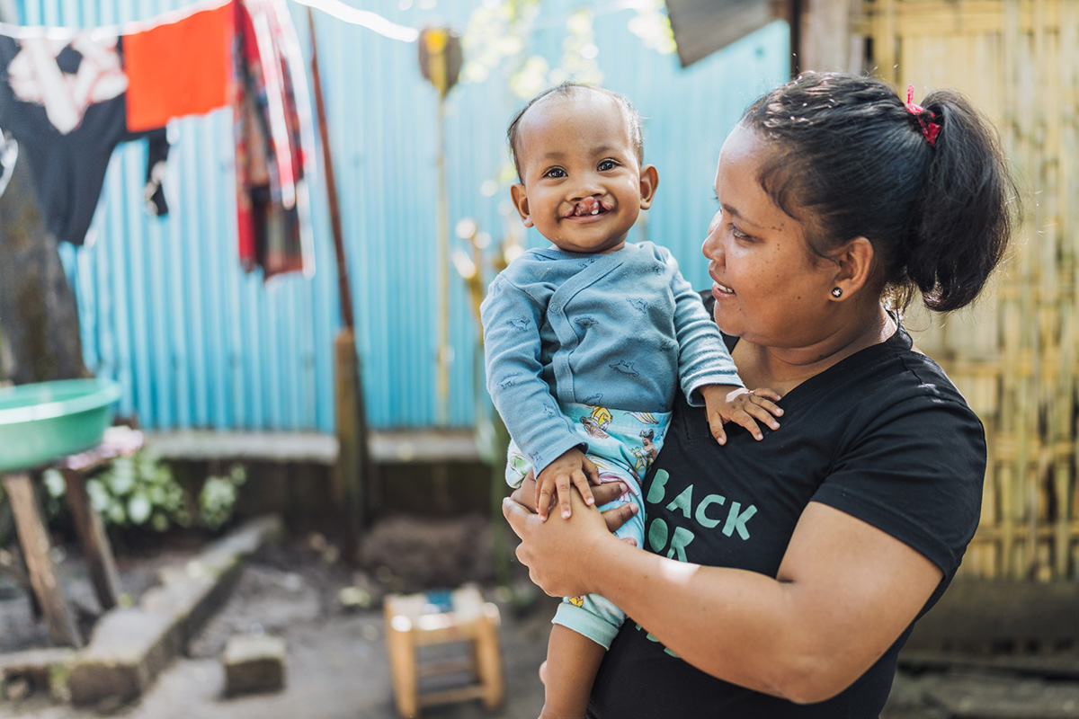 Anjara, first cleft lip patient to receive surgery in Madagascar in 2024. © Mercy Ships  